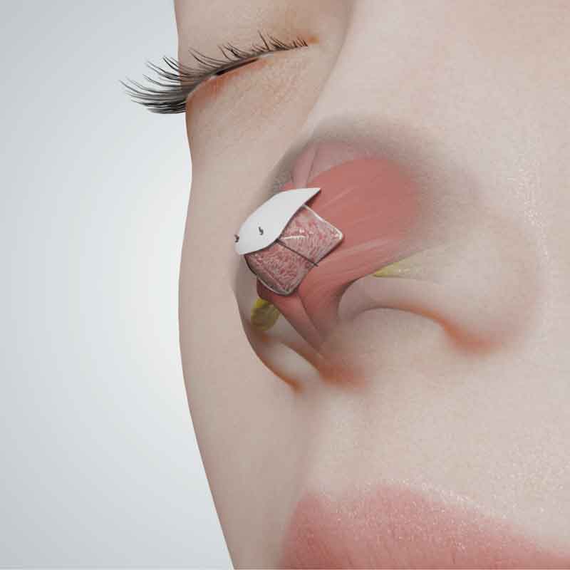 3D rendered view from nasal tip rhinoplasty surgery animation